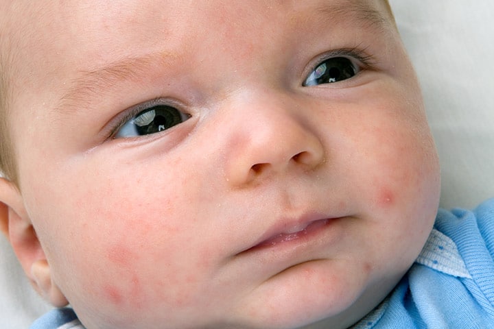 Petechiae In Babies – Causes, Diagnosis & Treatments You Should Be Aware Of