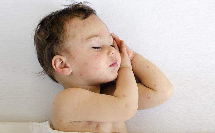 5 Effective Treatments To Cure Bug Bites In Babies