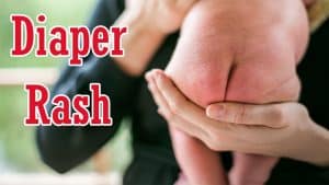 diaper rash