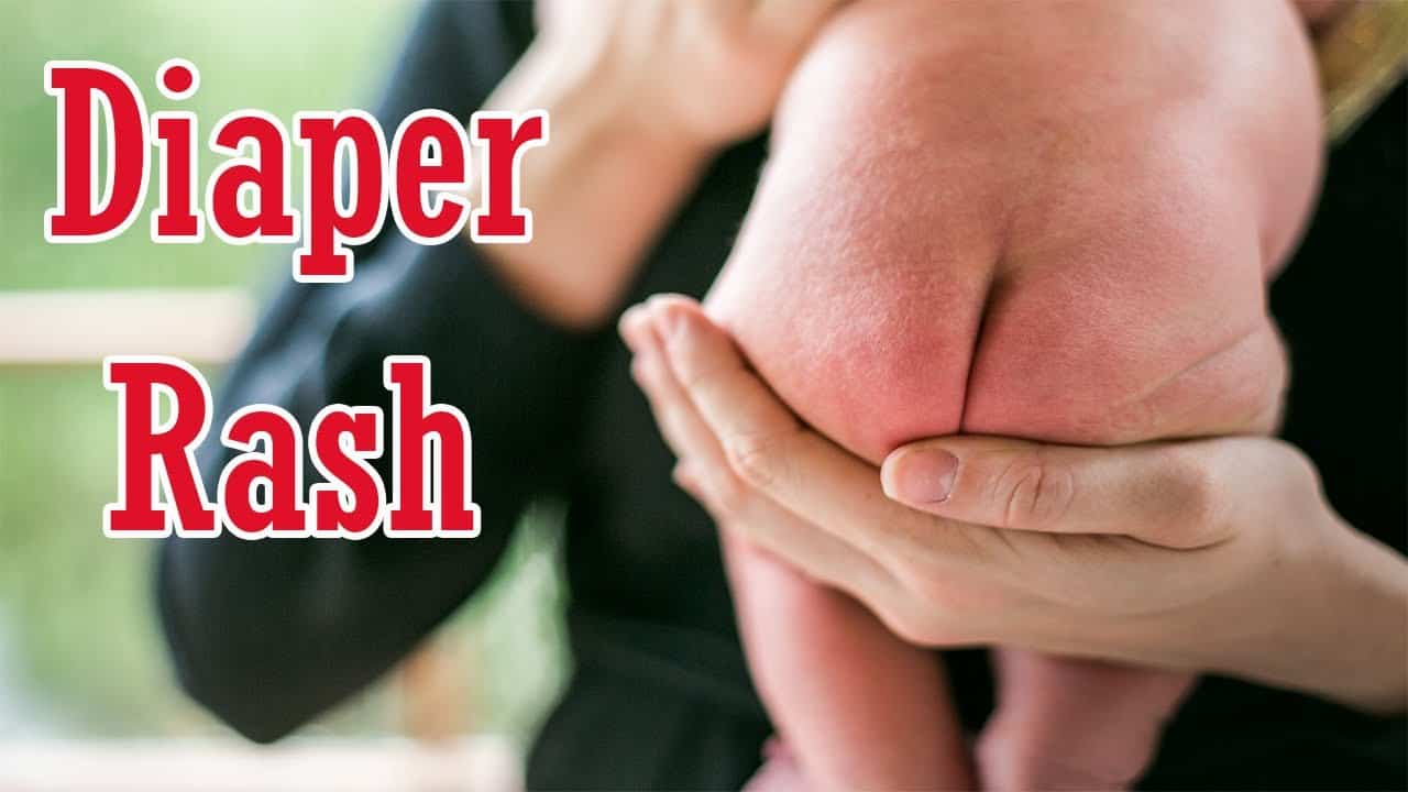 Diaper Rash – how to recognize it