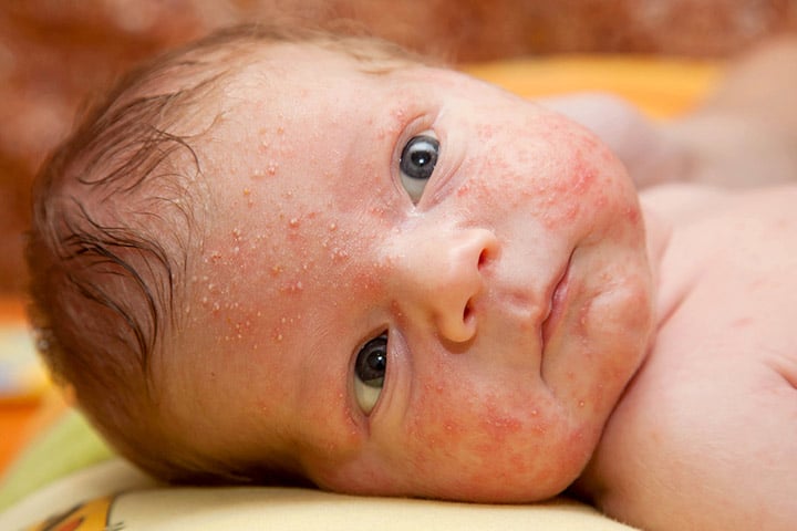4 Simple Steps To Treat Burns In Babies